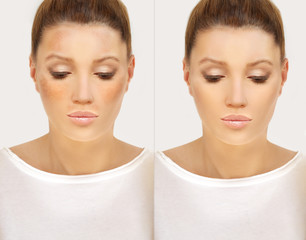 Dark spots, freckles,hyperpigmentation(melasma or chloasma).