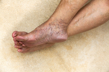 Varicose veins on legs with feet in Senior woman