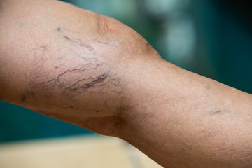 Varicose veins on a leg in Senior woman