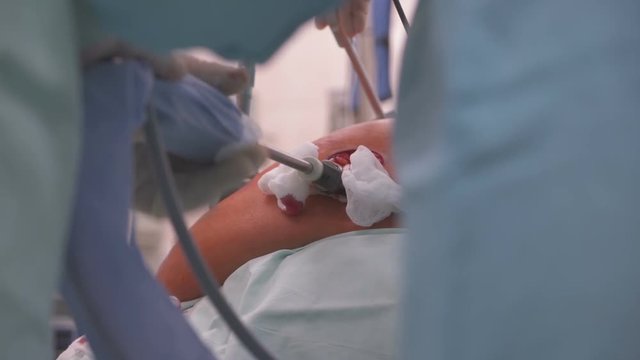 Surgeon performs an endoscopic operation on the organs of the abdominal cavity