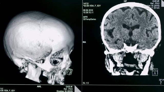 Skull model rotates on a screen, close up. Medical machine creates a model of a patient's skull.
