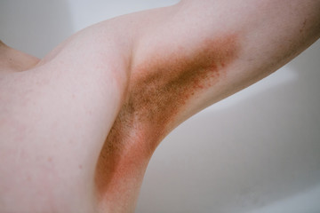 A man with a skin disease in the armpit area. Prickly heat.