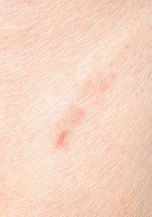 Fototapeta premium abrasion on the leg