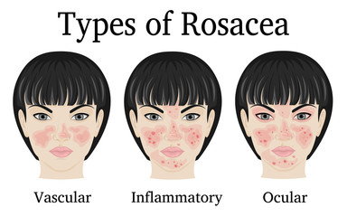 Three types of Rosacea - vascular, inflammatory and ocular for example depicted on the face of a young woman