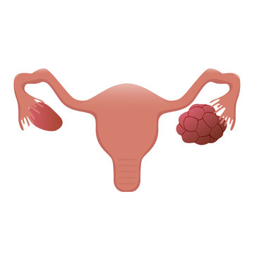 Polycystic ovary illustration
