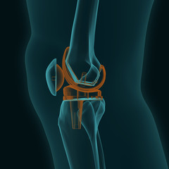 X-ray of a human knee in the lateral projection with knee replacement