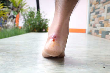 Close up sore hurt pain lesion on foot from shoes pinch because shoes is tight,