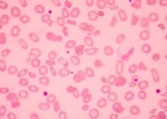Thalassemia blood smear abnormal red blood cells morphology.
