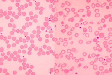 Left normal and right thalassemia blood smear.