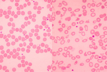 Left normal and right thalassemia blood smear.