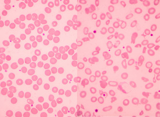Left normal and right thalassemia blood smear.