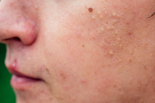 pimples on the face of a man close-ups