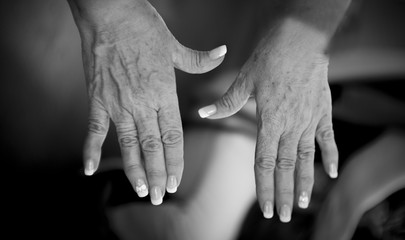 Woman hands with rheumatism arthritis and skin blemishes