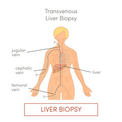 Transvenous liver biopsy
