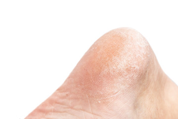 Close-up of female dry cracked heel.