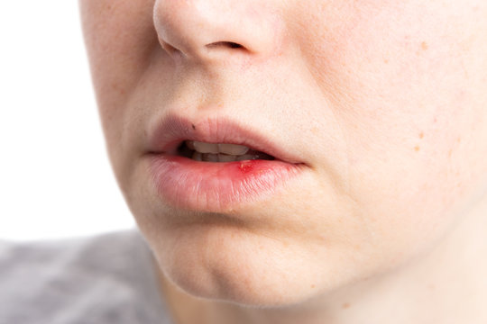 Pustule ulceration or aphtae on woman lip.