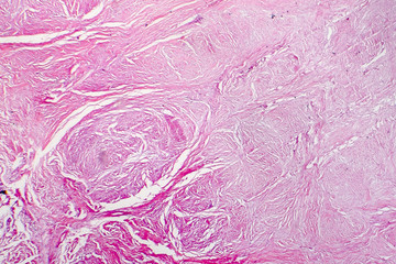 Light micrograph of scar tissue. Photo under microscope of a scar formed during wound healing