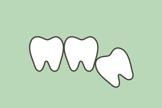 wisdom tooth ( angular or mesial impaction ) affect to other teeth