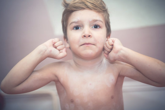 Cute boy showing chickenpox on his skin.