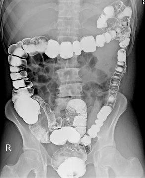 Barium enema of a man demonstrated the normal rectum and cecum.