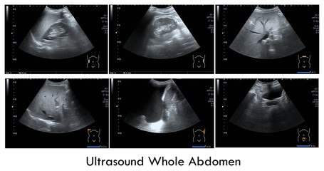 Ultrasound  whole abdomen.Impression: Massive Lt pleural effusion. - Mild fatty liver.