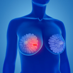 3d illustration of breast cancer - Mammakarzinom