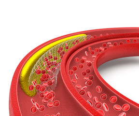 Cholesterol plaque in artery, stent angioplasty, 3d illustration