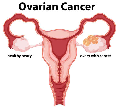Woman Ovarian Cancer concept drawing
