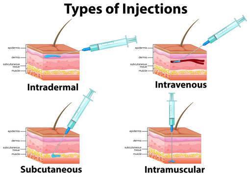 A Set of Type of Injections