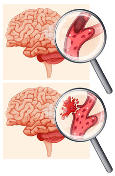 Human Brain and Hemorrhagic Stroke