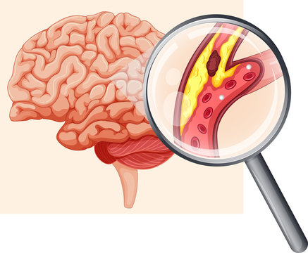 Human Brain with Atherosclerosis