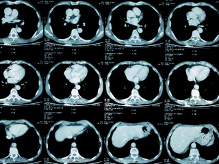 film x-ray of chest , lung cancer from patient who love smoking cigarette , health concept