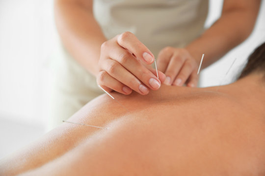 Young woman undergoing acupuncture treatment in salon, closeup