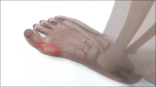 Hallux valgus x-ray anatomical vision
