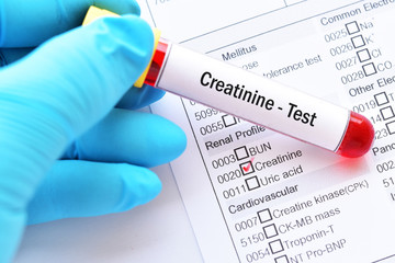 Blood sample for creatinine test, diagnosis for renal disease