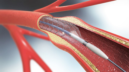 3d illustration of stent implantation for supporting blood circulation into blood vessels - obrazy, fototapety, plakaty