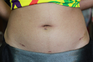 The scar of a young Asian women myoma case after myomectomy by laparoscopy for 1 week.