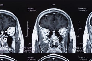 brain mri scan