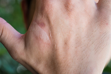 Fototapeta premium burning pain wound from burn on man's hand,