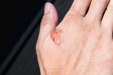 Naklejka premium burning pain wound from burn on man's hand,