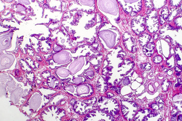 Benign prostatic hyperplasia. Micrograph shows dilated glands, papillary projections inside the lumen of the glands, cystic dilatation with accumulation of secretory material. Photo under microscope