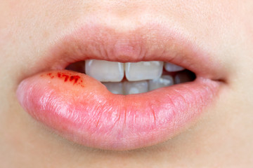 Orale Lippen Herpes Infektion, / Lippe aufgebissen, 