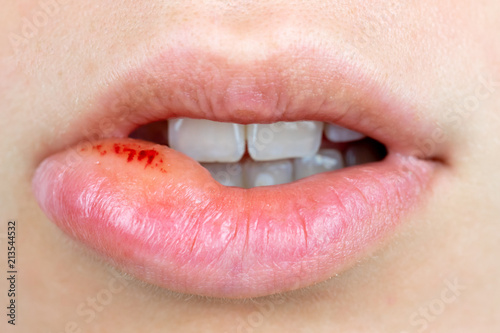 Orale Lippen Herpes Infektion Lippe Aufgebissen Stockfotos Und