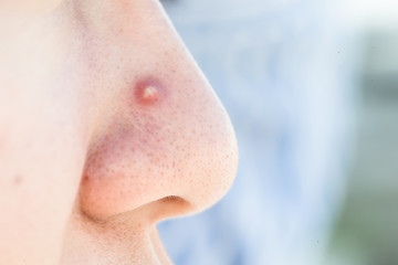 close up of facial acne