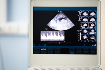 The screen of an ultrasound device with a sagittal brain scan and the measurement of the resistance...