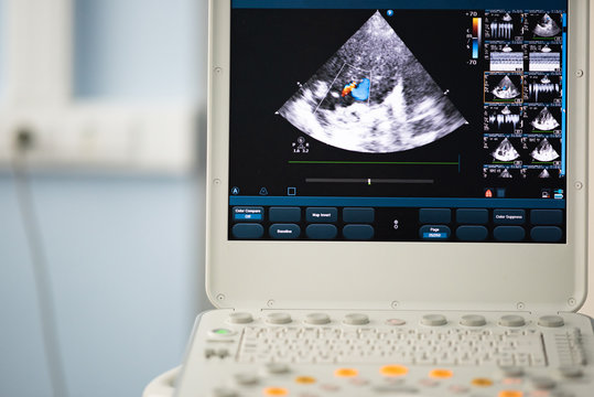 Screen of an ultrasound device with a heart scan. The Doppler method shows valve regurgitation.