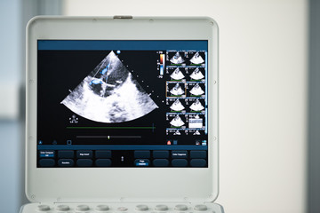 Screen of an ultrasound scanner with the image of tricuspid regurgitation by the Doppler method.