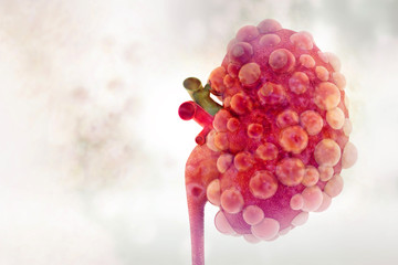 Kidney disease