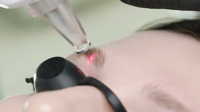 Laser removal of a permanent make-up on face. Closeup young woman receiving hardware correction of a tattoo on eyebrows procedure. Correction of imperfections on a face