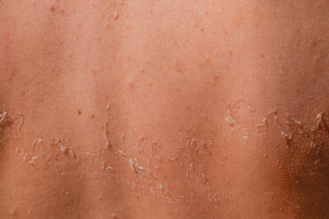 Fototapeta premium Sunburn on the skin of the back. Exfoliation, skin peels off. Dangerous sun tan
